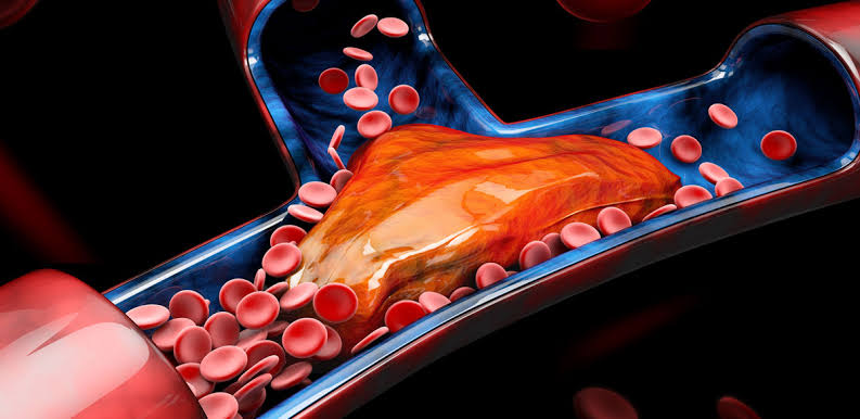 DVT Treatment