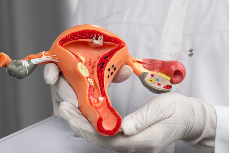 Uterine Fibroids